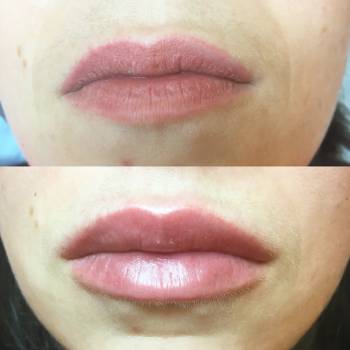 Фото с портфолио Анна косметолог 