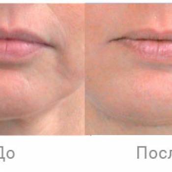 LPG массаж лица