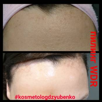 Осветляющие пилинги WDR