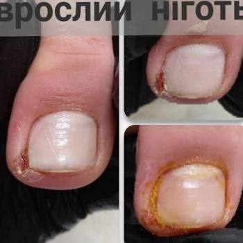 врослий ніготь