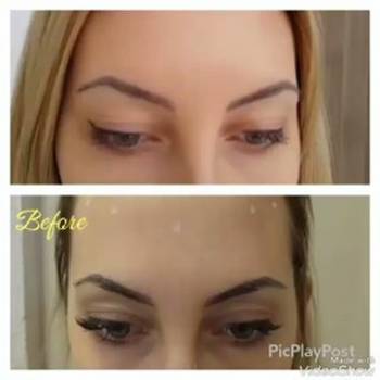 Коррекция мимических морщинок лба