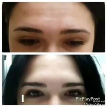 Коррекция мимических морщинок лба