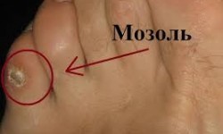 Удаление мозоли Харьков Косметологический центр E-Studio Харьков