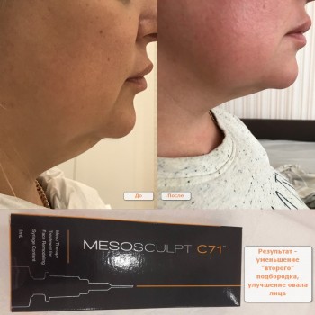 Пациентка 38-ми лет с возрастными изменениями овала лица, до