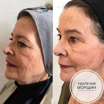 омоложение