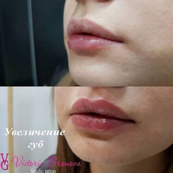 Увеличение губ 