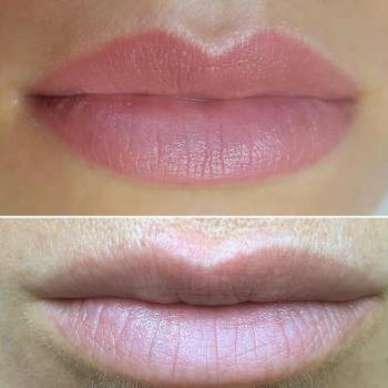 Зажившие губки, через месяц после процедуры, перед незначите