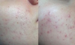 Пілінг Джесснера модифікований Косметологический центр O.L.Beauty Киев