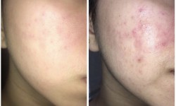 Голлівудський феруловий пілінг Косметологический центр O.L.Beauty Киев