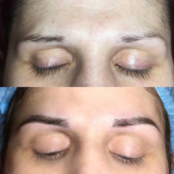 Микроблейдинг