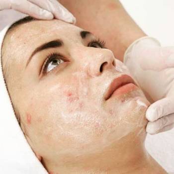 Анти акнэ программы избавят Вашу кожу от рубцов и неровносте