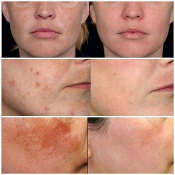 Уход за пигментирование Колей-самый сложный и длительный про