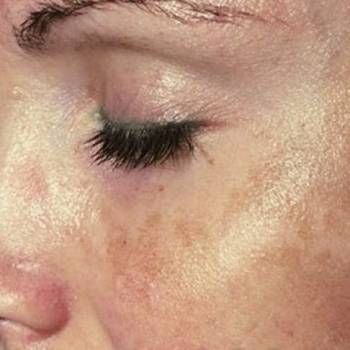 Защита кожи от УФ излучения-важный и необходимый метод профи