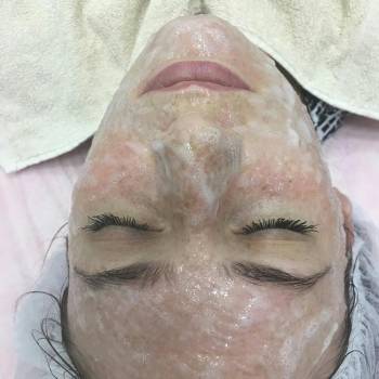 Карбокситерапия-волшебное преображение Вашей кожи! Осветлени