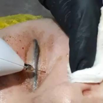 Плазмо лифт