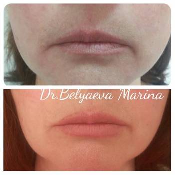 збільшення губ, корекціяз моршок