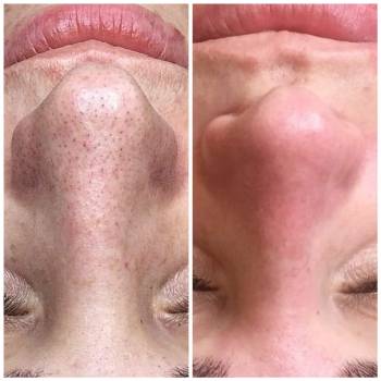 чистка комбинированная до и после