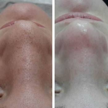 Результат комбинированной чистки лица