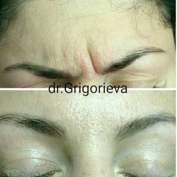 Иньекции ботокса, фото - косметолог Елена Григорьева
