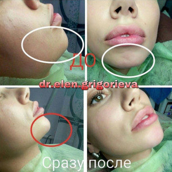 Коррекция подбородка, фото - косметолог Елена Григорьева