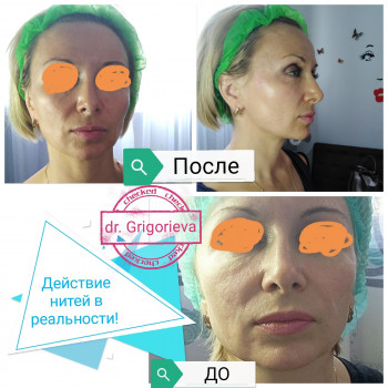 Нити Коги, фото - косметолог Елена Григорьева