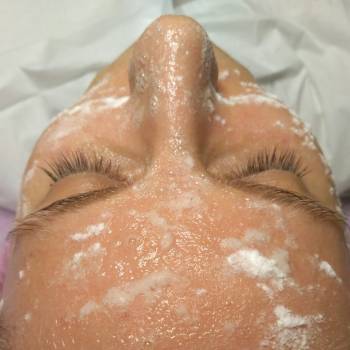 карбокситерапия medicare