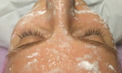 Неинвазивная карбокситерапия (без повреждения) Салон краси Абсолютно новая жизнь Запоріжжя