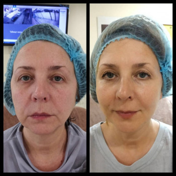 установлены полимолочные нити. Результат через 2 месяца