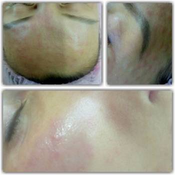 Мезотерапия