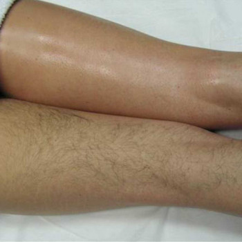 до и после удаление волос