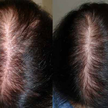 Дарсонваль
                    Косметологический центр Кокетка Запорожье