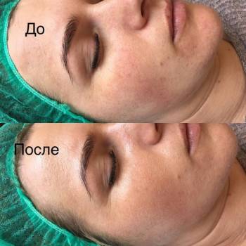 Лечение купероза