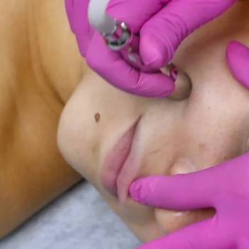 МИКРОДЕРМАБРАЗИЯ 