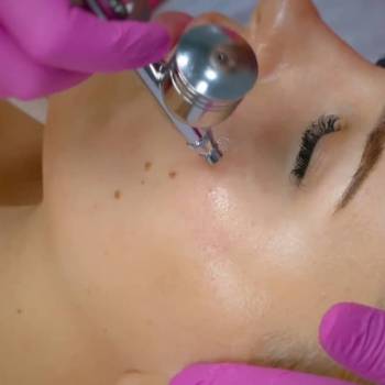 Кислородная мезотерапия 