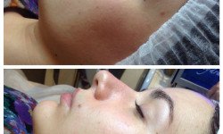 Комплекс "Дермапэн" или "Дермаштамп" по инъекционному мезококтейлю! Косметолог Ирина Київ