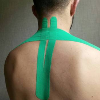 Кинезиотейпирование