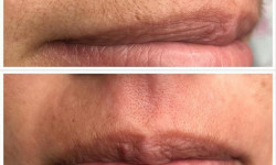 Тридинг верхней губы Бровист Ольга Подшивалова Кривой Рог