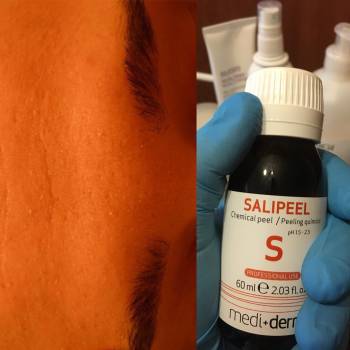 Химический пилинг