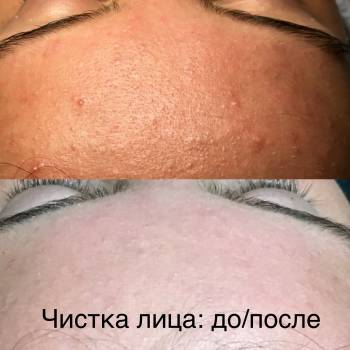 Чистка лица: до/после