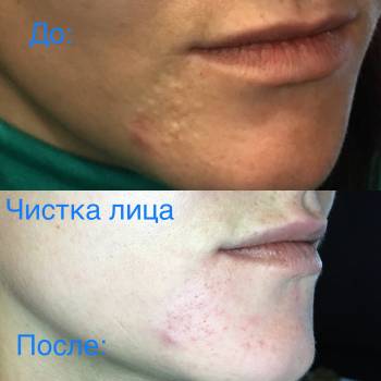 Чистка лица:до/после