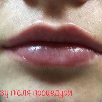 Контурна пластика губ-після