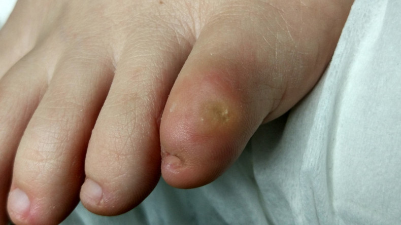 Стержневая мозоль на мищинце, фото - Майстер манікюру Ксения Нойлингер