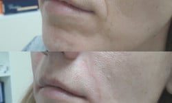 Контурна пластика обличчя Врач-косметолог Екатерина Пшеничная Киев