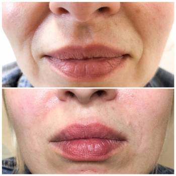 коррекция носогубных складок