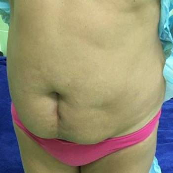 липосакция до