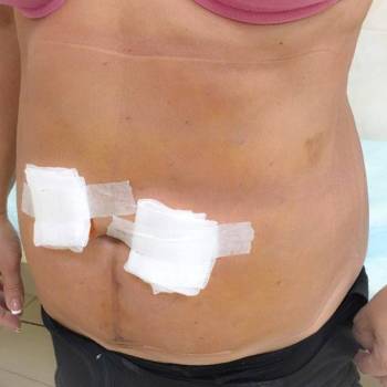 липосакция после