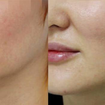 удаление комков Биша