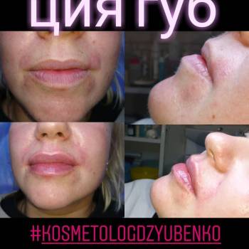 Аугментация губ