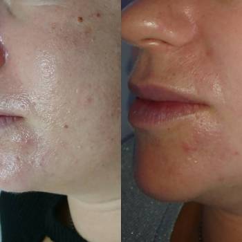 Пилинги WDR 4 процедуры