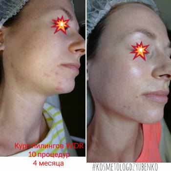 Курс пилингов WDR 